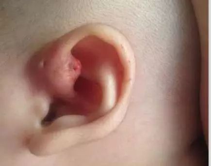 孩子耳朵长肉芽还流脓必须手术么,富贵包流血流脓是怎么回事