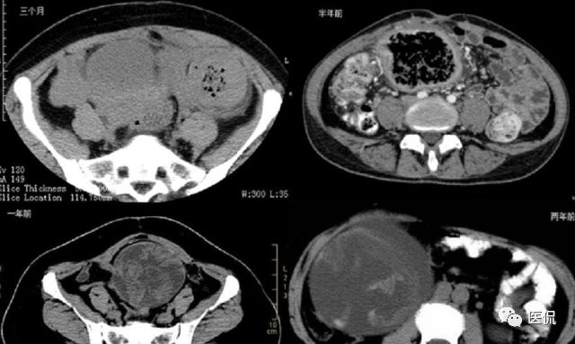 手术纱布遗留在体内可以吸收吗,手术纱布忘了取出会怎样