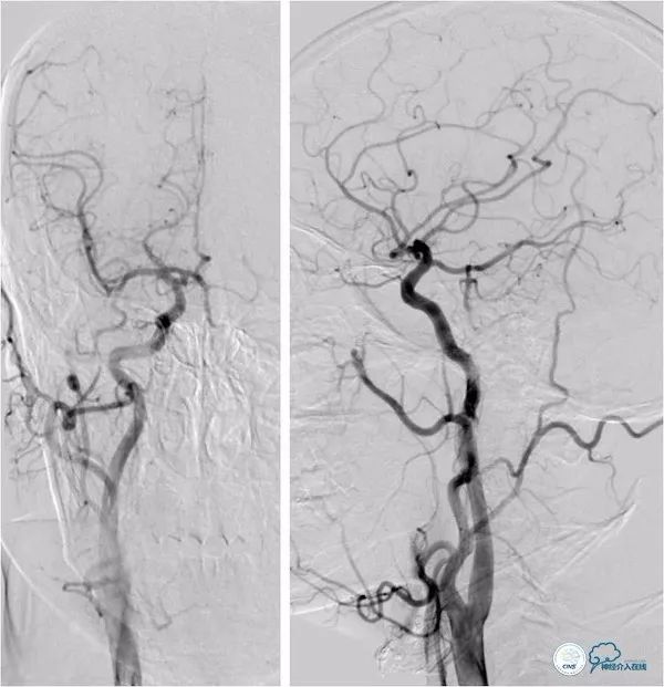 天坛医院做椎动脉狭窄多少要手术,天坛椎动脉狭窄