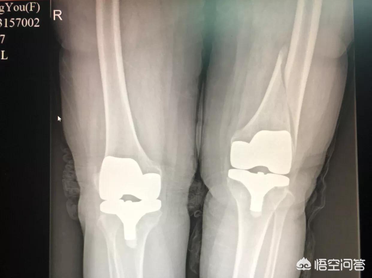 脚踝骨折取钢板后还用打石膏吗,距骨骨折固定钢板后多久拆除石膏