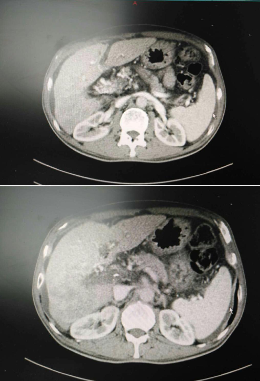 周仲国评价肝癌病例,周仲国分享肝癌早期复发