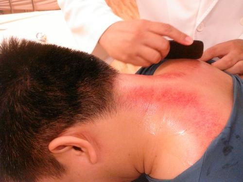 感冒喉咙痛刮痧刮哪个部位呢,感冒咳嗽刮痧刮什么部位