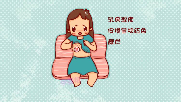 哺乳期乳房湿疹可以用炉甘石吗,哺乳期乳房湿疹买什么药膏擦