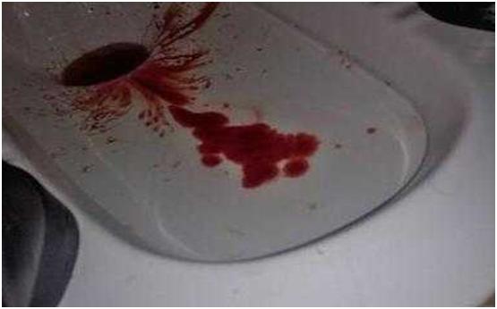 痔疮分内痔疮外痔疮吗,痔疮手术后痔疮更严重