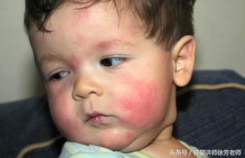 宝宝换奶粉后身上起红疹,宝宝换奶粉身上起红点怎么办