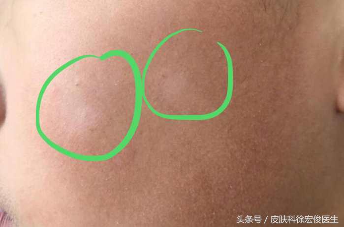 儿童脸上白斑是不是虫斑,儿童脸上的白斑是白癫风吗