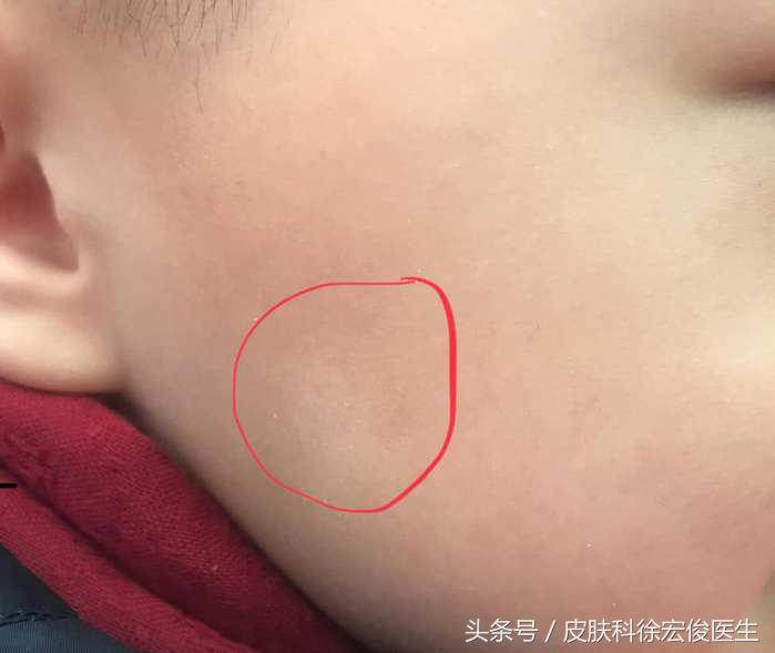 儿童脸上白斑是不是虫斑,儿童脸上的白斑是白癫风吗