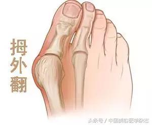 大脚拇指外翻矫正治疗,大脚骨拇指外翻真的能矫正好吗