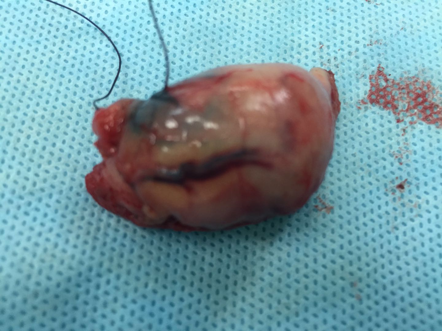 胃肠道间质瘤在临床上有什么特点,胃肠道间质瘤会有什么特征