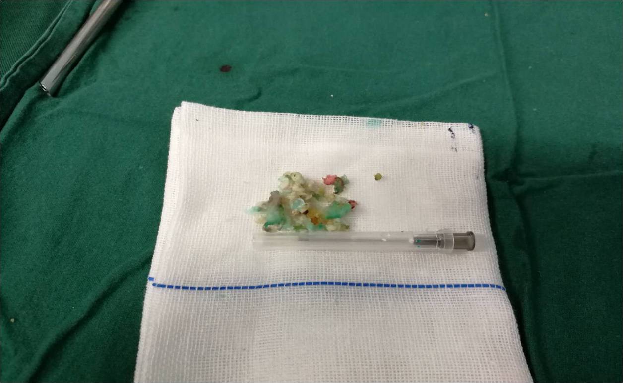 腰突和腰脱的磁共振片子,腰脱磁共振