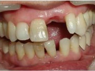 缺了牙齿不补会怎么样,缺了一颗牙齿不种牙矫正可以吗