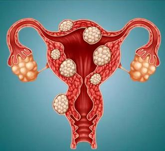 小肌瘤一定要全部剔除吗？