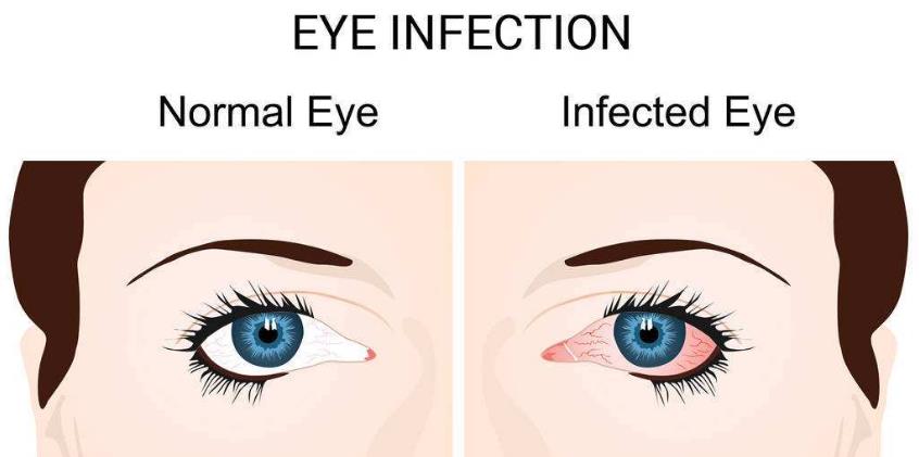 眼睛发痒说是结膜炎反反复复,一觉醒来眼睛又红又痒