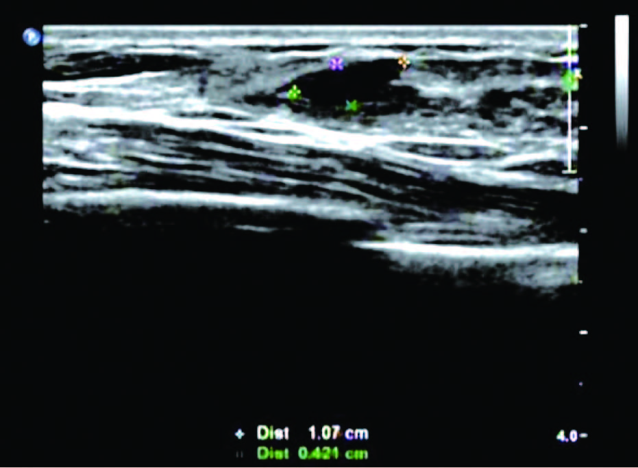 乳腺增生3级结节严重吗,女性乳腺增生怎么治最好