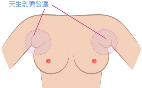 女性副乳的危害,什么是副乳副乳的危害有哪些