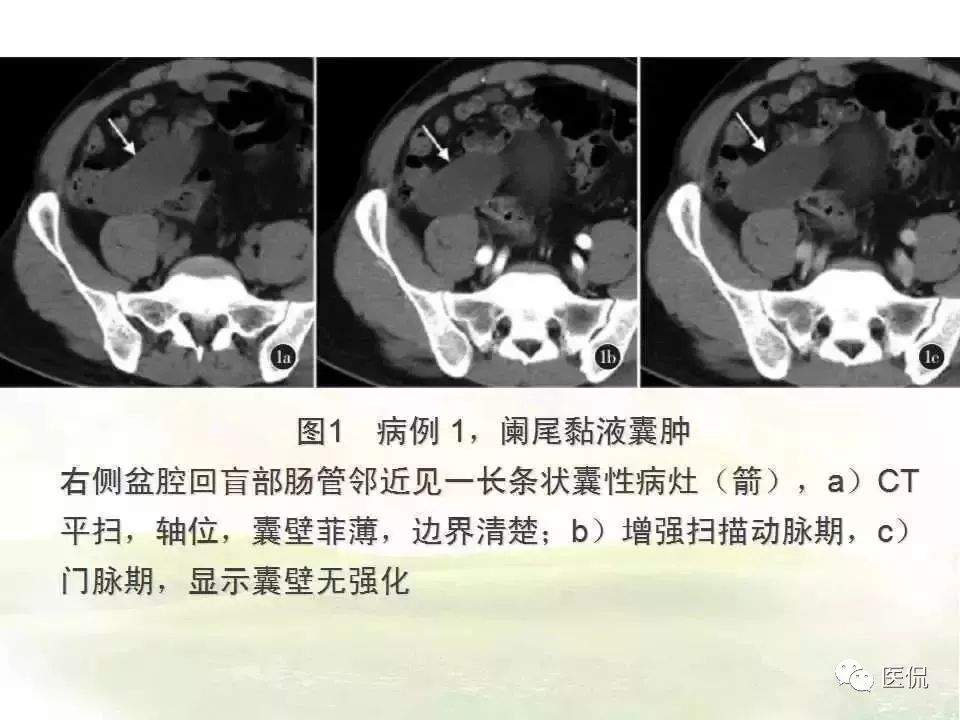 阑尾炎特殊检查讲解视频,阑尾炎病例分析的模板