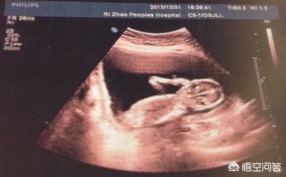 手把手教你轻松看懂产检b超单,孕初期b超看胎儿发育看哪些