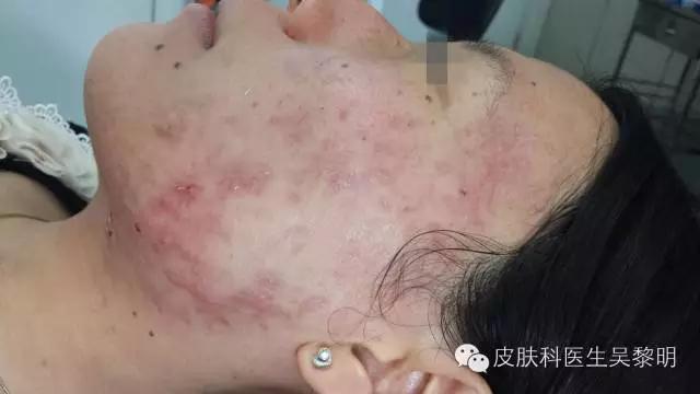 透明质酸护肤品功效,透明质酸是修复皮肤敏感成分