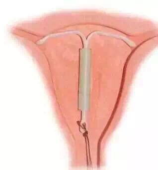 特么上环导致炎症出血的痛楚谁人懂！男人就不能去结扎吗？