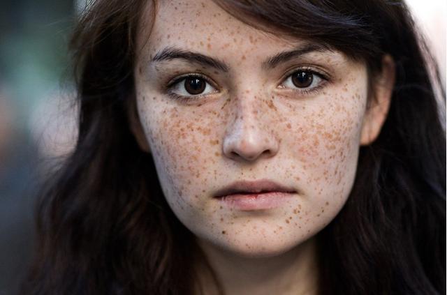 怎样治疗脸上的色素斑,色素斑怎么消除最快最有效