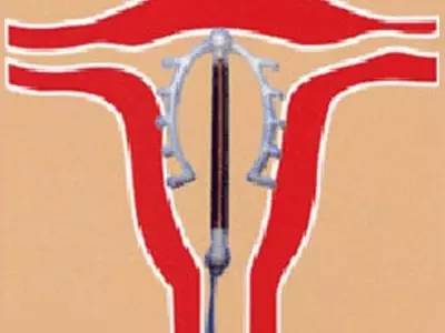 女性上环对血压有影响吗,女性上环前需要注意什么