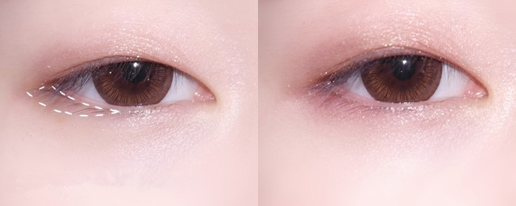 怎么不整容内双变成外双,不用整容缩小鼻头