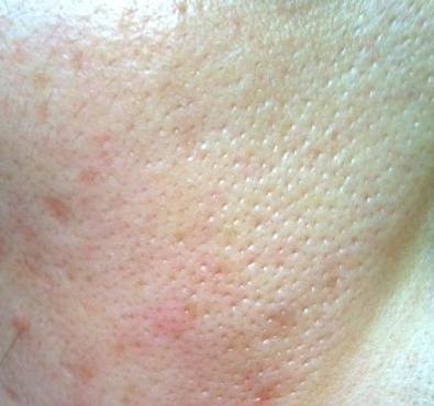 毛孔粗大肌肤怎么改善,毛孔粗大肌肤修复方案