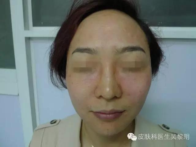 透明质酸护肤品功效,透明质酸是修复皮肤敏感成分