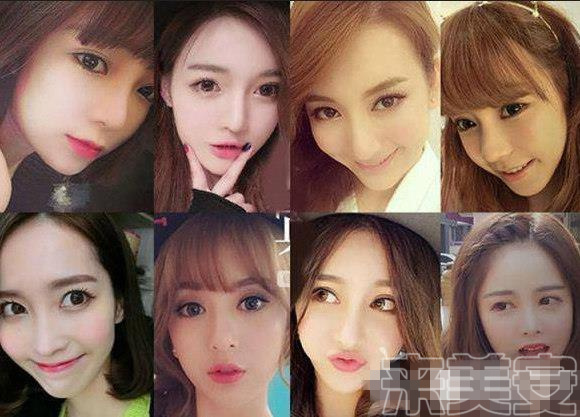 平行双眼皮割成了欧式双眼皮,割了个欧式双眼皮