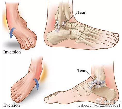 凯凯王--赵医生指导你如何处理急性踝关节扭伤！