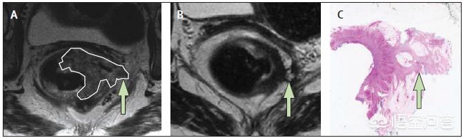 放疗与化疗不同之处,化疗与放疗的区别和优缺点