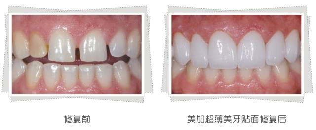 牙齿发黄让牙齿美白几个小妙招,牙齿不白笑容不好看