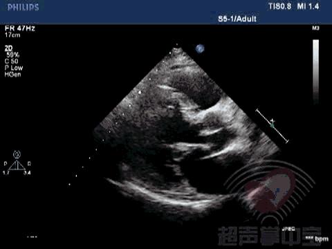 二尖瓣充血性囊肿,二尖瓣血性囊肿是什么意思