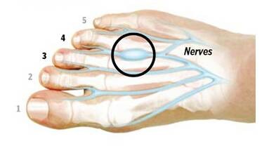 足跟痛跖筋膜炎,足底筋膜炎跖痛症
