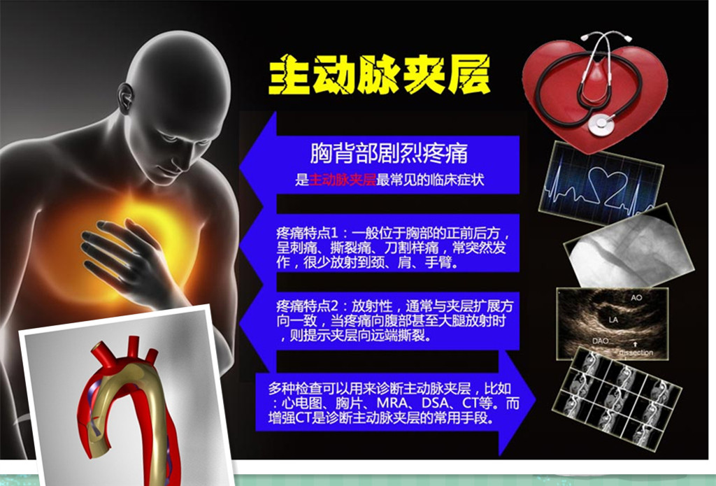 警惕凶险的主动脉夹层你了解多少,主动脉夹层科普动画视频