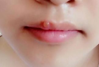 嘴唇上火长泡,变成黑印怎么办？学会自己去火，去黑印