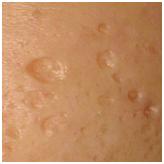 痘痘没了留下痘印怎么解决,痘痘没了留下的红斑怎么办