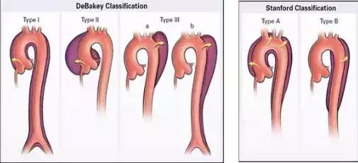 主动脉夹层动脉瘤如何检查和防治,主动脉夹层动脉瘤的超声表现