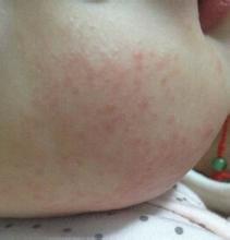 湿疹发作记住这些方法远离湿疹,湿疹很严重反反复复怎么治疗