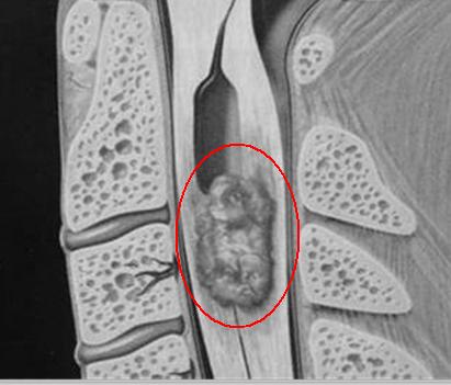 脖子疼要看关节骨科还是脊柱科,脖子疼应该看神经外科还是内科