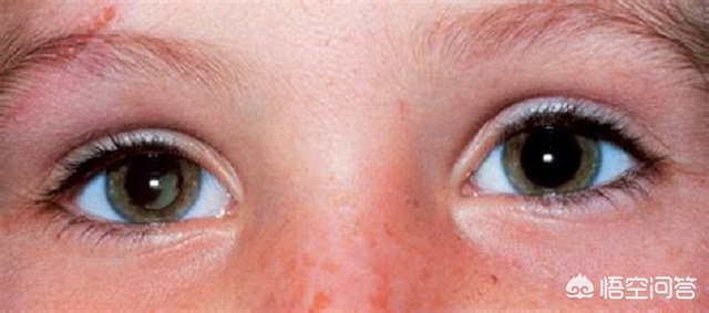 先天性视网膜母细胞瘤可以治疗吗,1岁多宝宝得了视网膜母细胞瘤