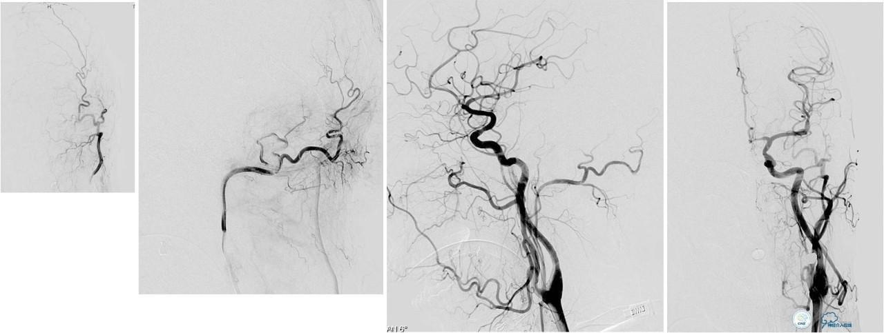 球囊辅助Onyx栓塞治疗硬脑膜动静脉瘘（DAVF）