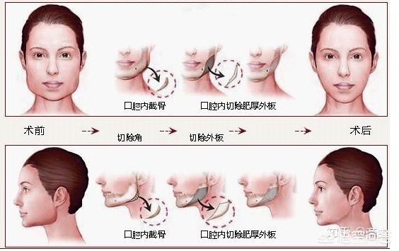 咬肌大脸颊凹适合瘦脸吗,下颌骨宽咬肌大如何瘦脸