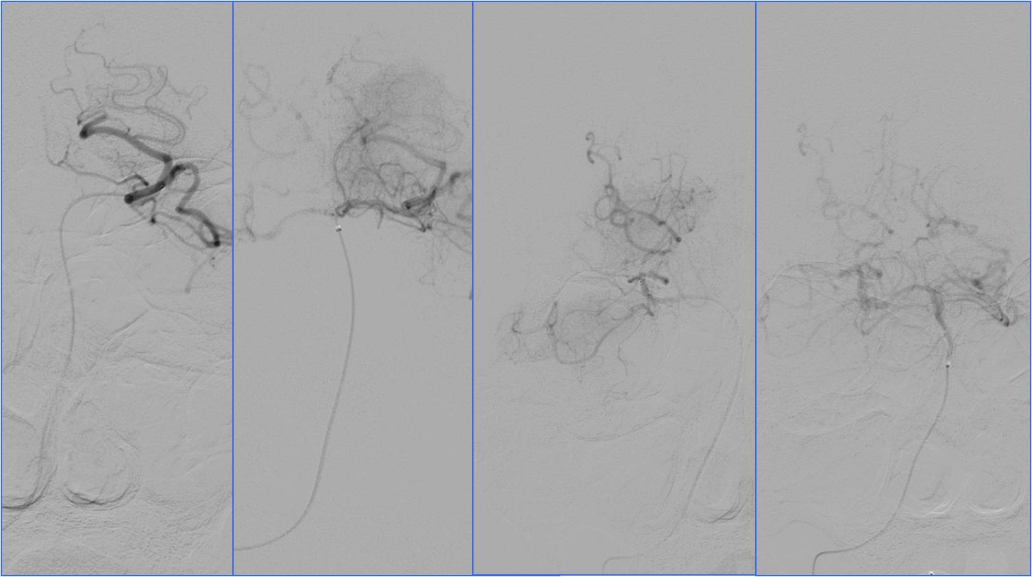缺血性脑卒中术后管理,急性缺血性脑卒中血管内治疗