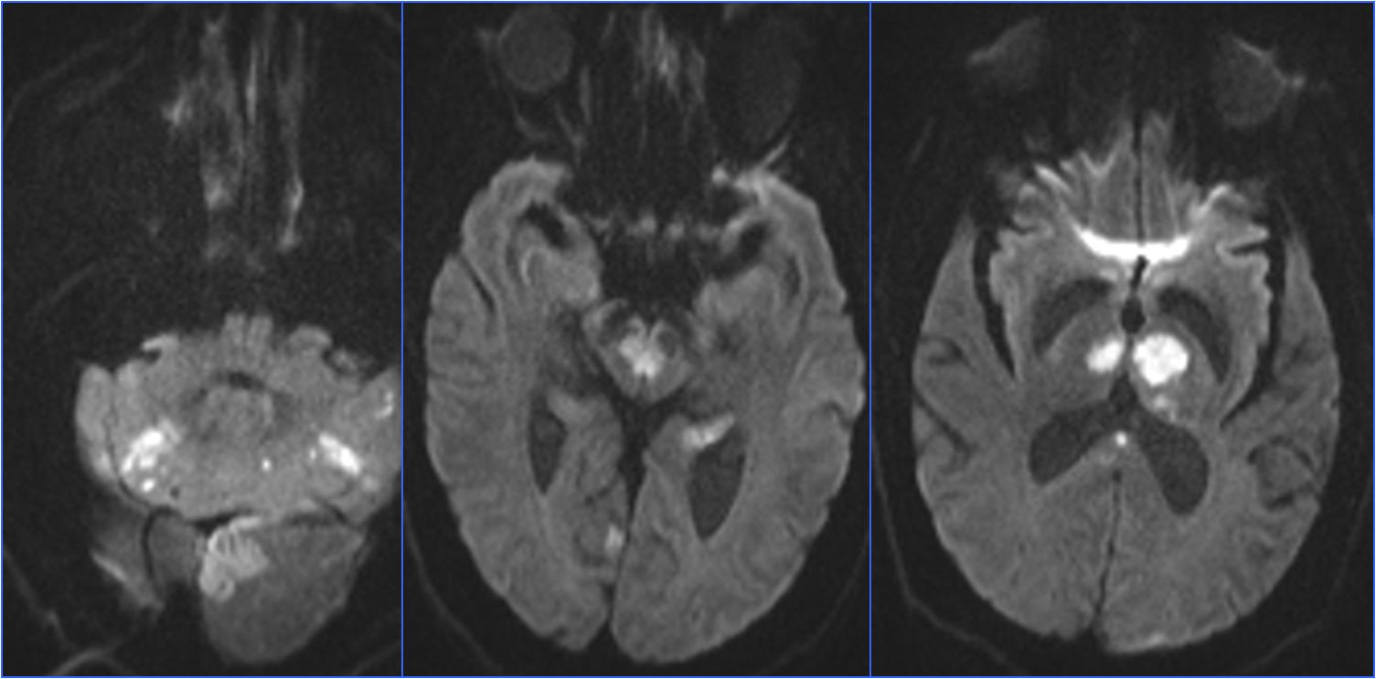缺血性脑卒中术后管理,急性缺血性脑卒中血管内治疗