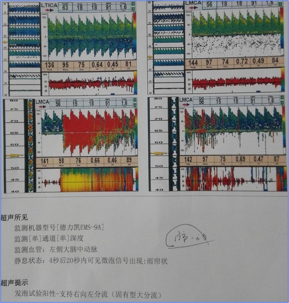 缺血性脑卒中术后管理,急性缺血性脑卒中血管内治疗