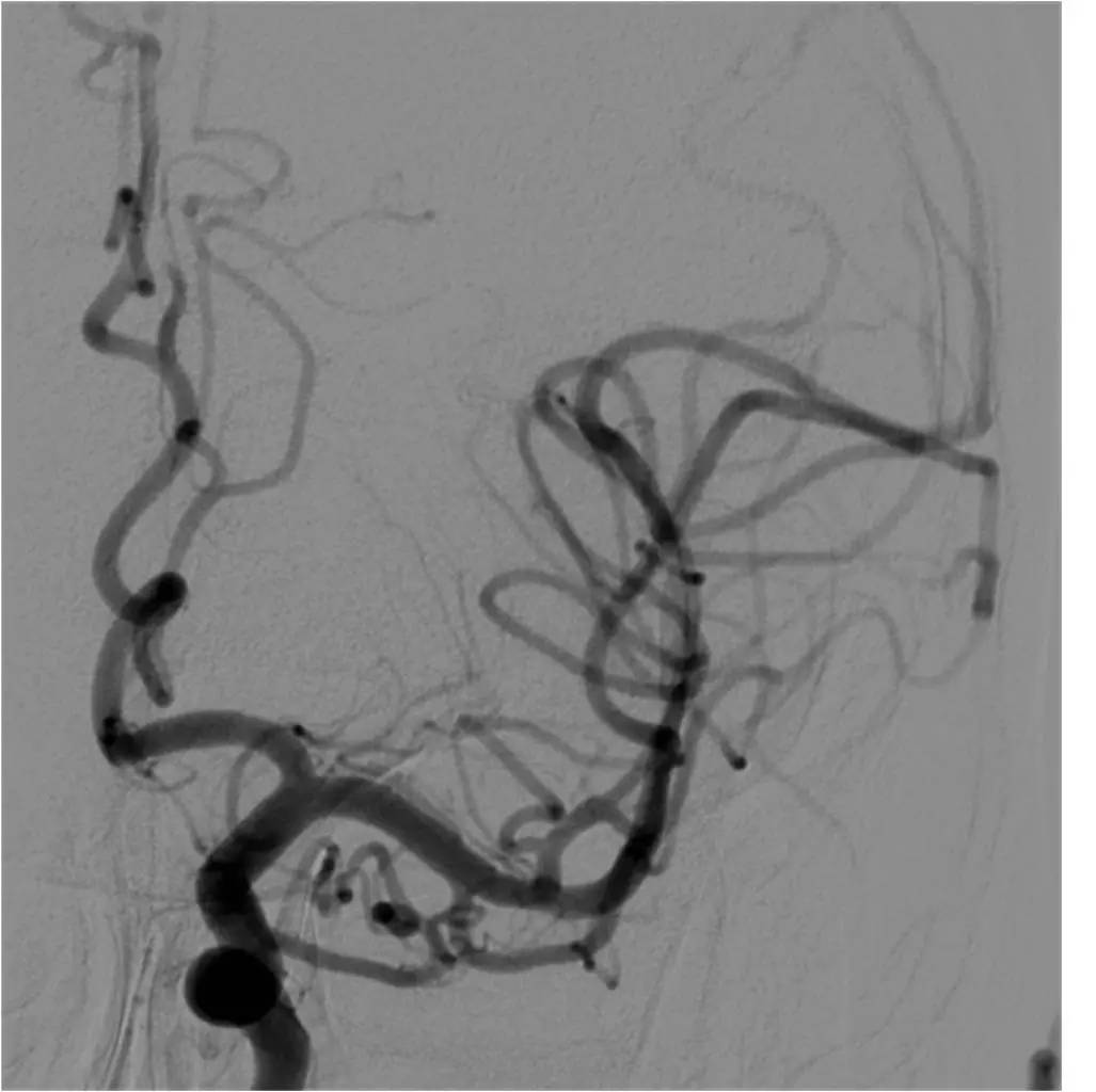急性缺血性脑卒中血管内治疗,缺血性脑血管病的抗血小板药治疗