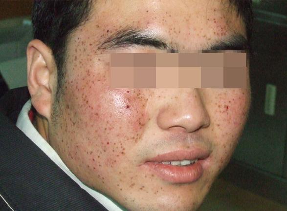 男性怎么治疗由电脑辐射引起的*褐斑黄**