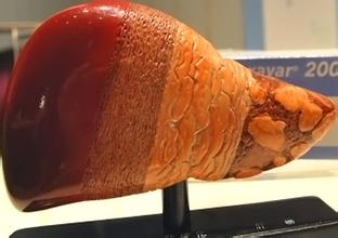 小肝癌手术后会不复发吗,肝癌手术后复发怎么治疗