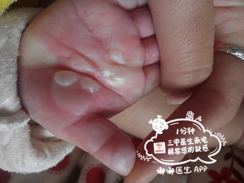 宝宝烫伤百分之二十五严重吗,宝宝烫伤快好了妈妈还要忌口吗